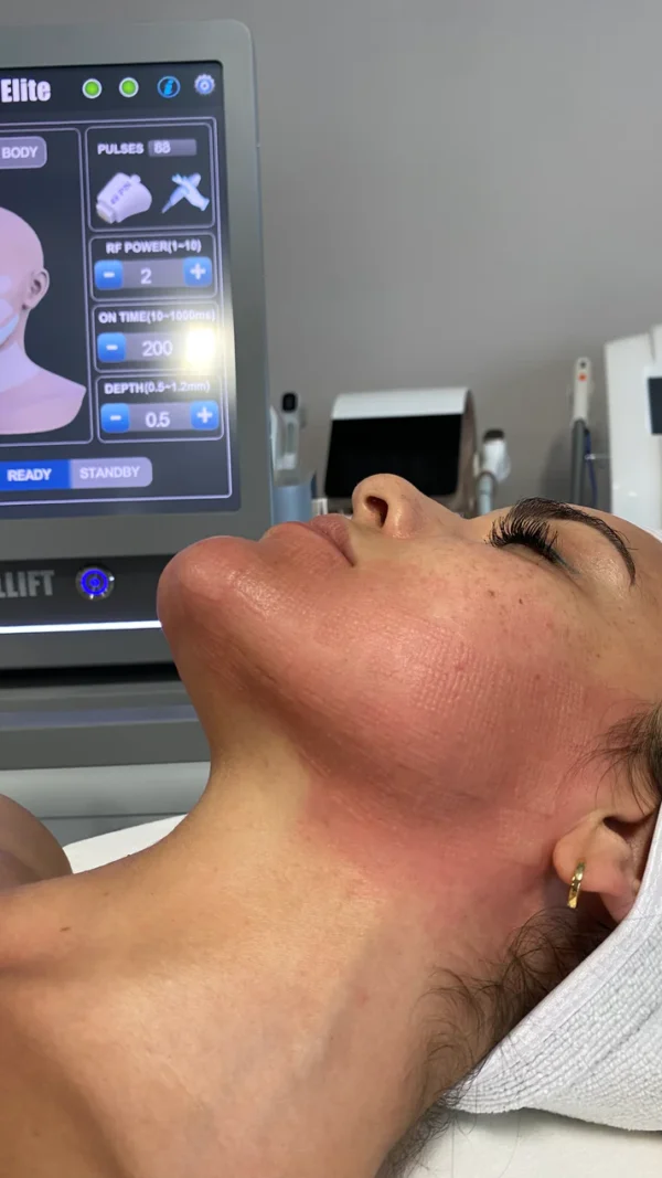 Goldskin Elite Radiofrequency Microneedling & Fractional RF - Image 4