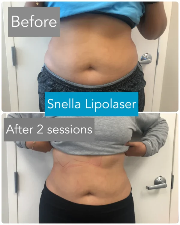 Snella Body Lipo Contouring Pads - Image 4