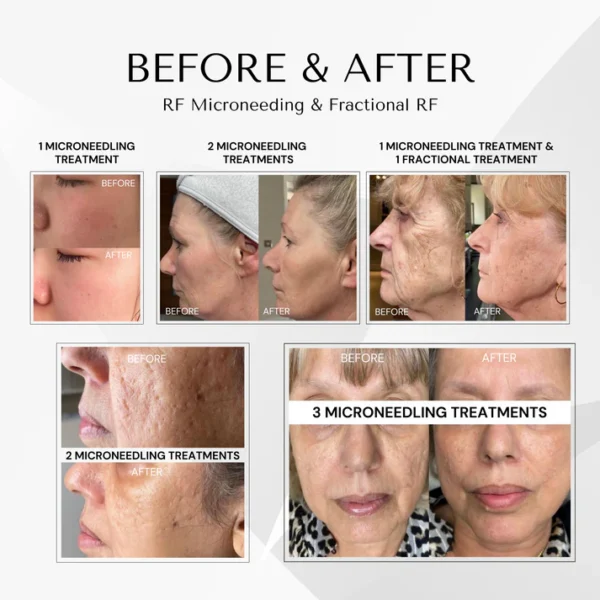 Goldskin Elite Radiofrequency Microneedling & Fractional RF - Image 2